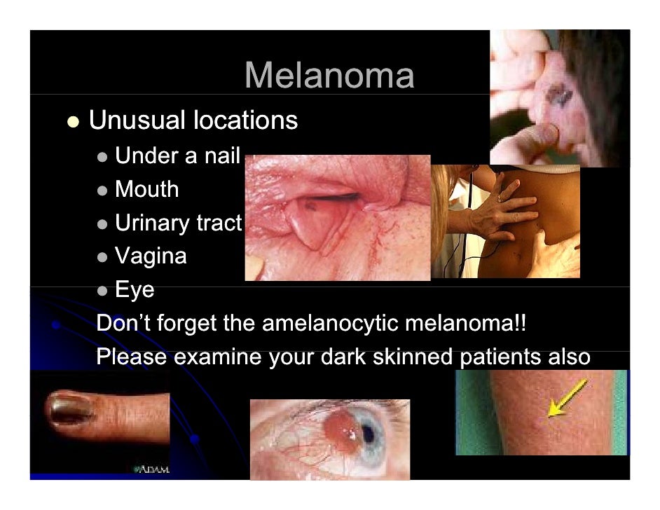 melanoma on the vagina Latex satis fashion